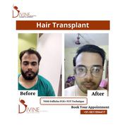 Hair transplant in chennai - surgery cost & procedure by doctor