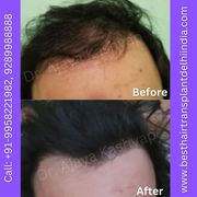 Best Hair Transplant Surgeon in Delhi