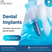 Dental Implants in Gurgaon