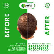 hair transplant clinic in hyderabad