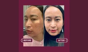  Pigmentation treatment in hyderabad