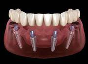 dentist veneers in mumbai
