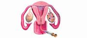 IUI Treatment Cost In Bangalore - Fertility Hospital Near Me 