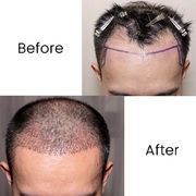 Hair Transplantation Treatment in Chennai