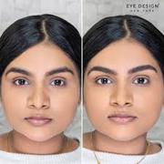 Eyebrow Lift Surgery in Lucknow