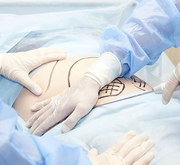 Top Hysterectomy Doctor in Ahmedabad