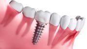 Dental Implant in India