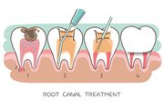 Best Root Canal Treatment in India