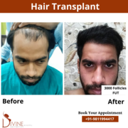 Unshaven FUE Hair Transplant in Delhi