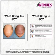 Cost of Hair Transplant in Ahmedabad,  Gujarat