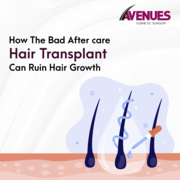Affordable hair transplant cost in Ahmedabad,  Avenues cosmetic.
