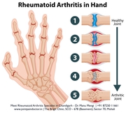 Free Your Hands from Rheumatoid Arthritis: Dr. Manu Mengi's Expertcare