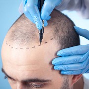 Best Hair Transplant in Mumbai | Hair Transplant Cost in Mumbai