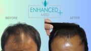 Best Hair Transplant Doctor Clinic in Delhi - Enhanced Medclinics