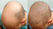 Leading Andheri hair transplant facility at High Hair Transplants