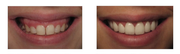 Smile Correction Cost in Gurgaon | Digital Smile Designing @9289288848