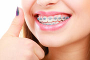 Teeth Braces in Gurgaon @9289288848