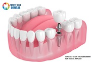 Dental Implants in Gurgaon @9289288848