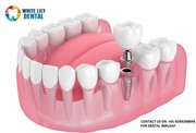 Dental Implants in Faridabad @9289288848