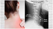 Neck Pain Treatment Meerut | Cervical Pain Treatment in Meerut