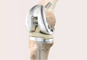 Revision Joint Replacement Surgery in Indore - Dr. Vinay Tantuway
