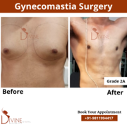 360 degree gynecomastia surgery in india – procedure & doctor