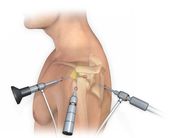 Robotic Joint Replacement