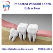 Impacted Wisdom Tooth Extraction | Wisdom Tooth Surgery