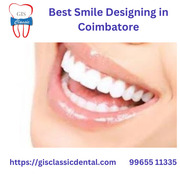 Best Smile Designing in Coimbatore | Dental Veneers CBE