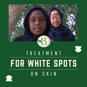 A Comprehensive Guide to Vitiligo and Homeopathic Treatment Options 