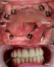 Best Dental Implants in Bangalore | Dental Implants cost in Goa