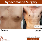 Gynecomastia Surgery & Male Chest Reduction