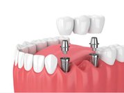 Dental Implants in Chennai – Akeela Dental