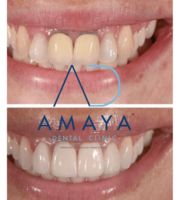 Best Dental Clinic in Bangalore - Amaya