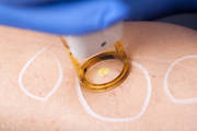 Laser Treatment for Varicose Veins in Hyderabad – Painless & Effective