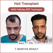 Hair Transplant In India