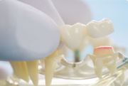 Capping of Tooth in Vikaspuri – Expert Dental Care for a Stronger