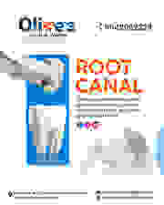 Why Early Root Canal Treatment Prevents Tooth Loss?