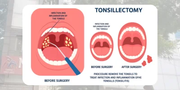 Best ENT Specialist Hyderabad | Tonsil Surgery & Adenoidectomy Treatme