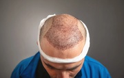 Hair Transplant Treatment
